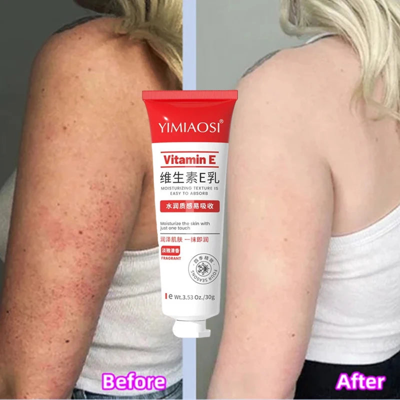 Reduce Chicken Skin Cream Repair Acne Hair Follicles Shrink Pores Fade Body Melanin Whiten Smooth Moisturize Skin Beauty Health