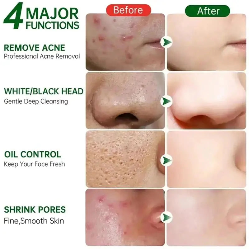 Reduce Chicken Skin Cream Repair Acne Hair Follicles Shrink Pores Fade Body Melanin Whiten Smooth Moisturize Skin Beauty Health