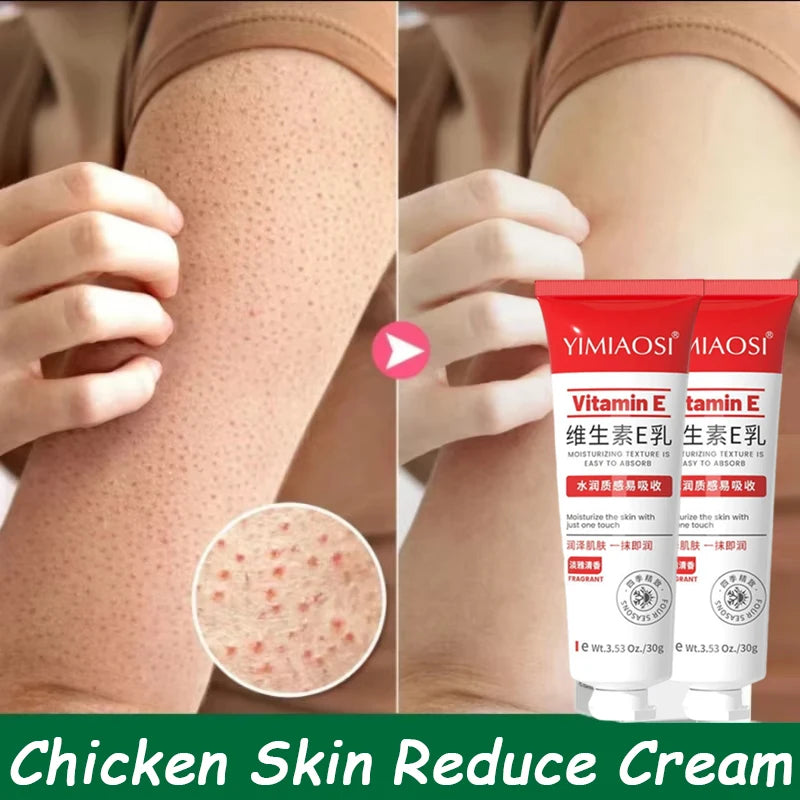 Reduce Chicken Skin Cream Repair Acne Hair Follicles Shrink Pores Fade Body Melanin Whiten Smooth Moisturize Skin Beauty Health