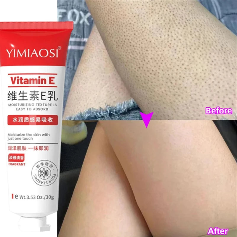 Reduce Chicken Skin Cream Repair Acne Hair Follicles Shrink Pores Fade Body Melanin Whiten Smooth Moisturize Skin Beauty Health
